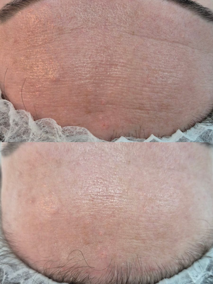 Hautbild der Stirn vor und nach der Behandlung