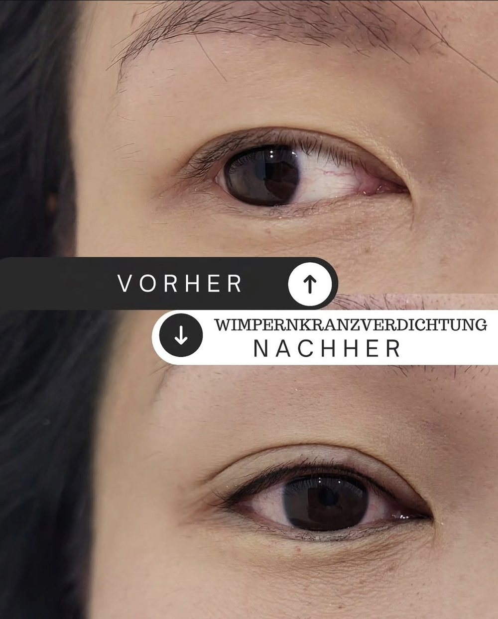 Lidrand vor und nach der Wimpernkranzverdichtung